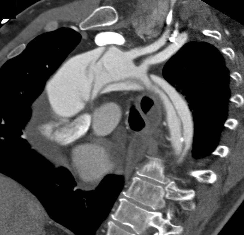 Type A Dissection with Hemopericardium - CTisus CT Scan