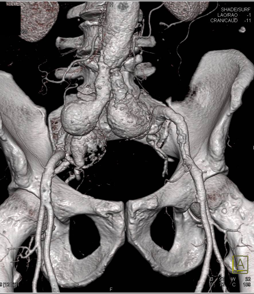 Iliac Artery Aneurysms - CTisus CT Scan