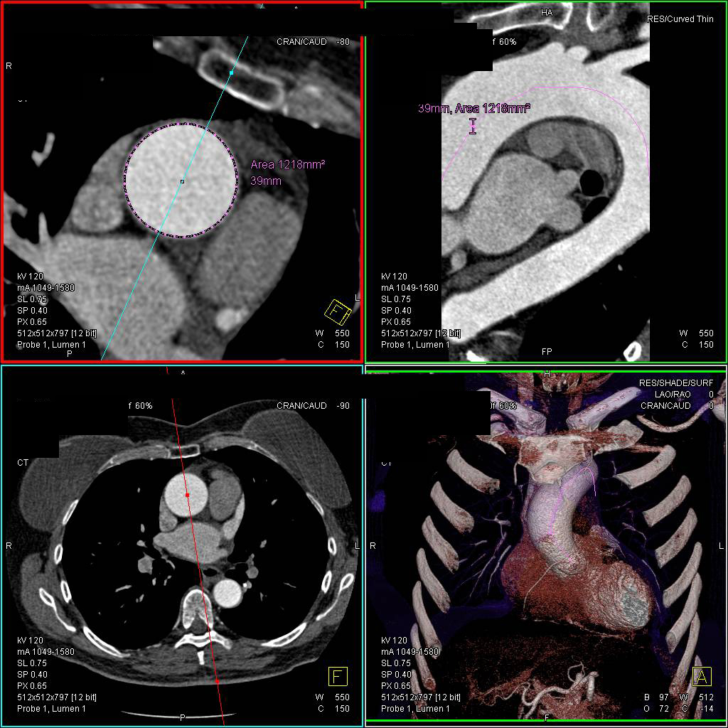 Dilated Aortic Root with 3D Mapping - CTisus CT Scan