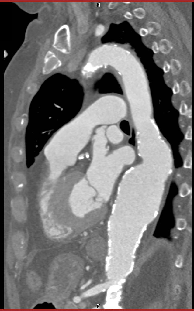 Aneurysmal Dilatation of Ascending and Descending Thoracic Aorta - CTisus CT Scan