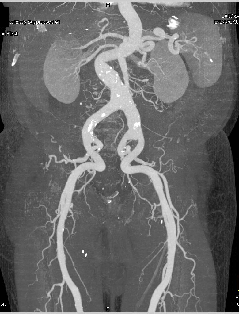 CTA Runoff with Left Popliteal Artery Aneurysm and Repaired Right Popliteal Artery Aneurysm - CTisus CT Scan