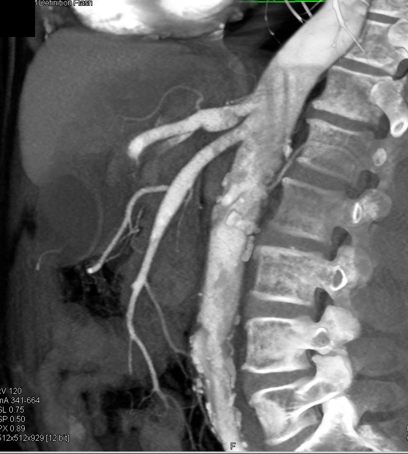 Focal Aneurysm with Dissection in Proximal Celiac Axis - CTisus CT Scan