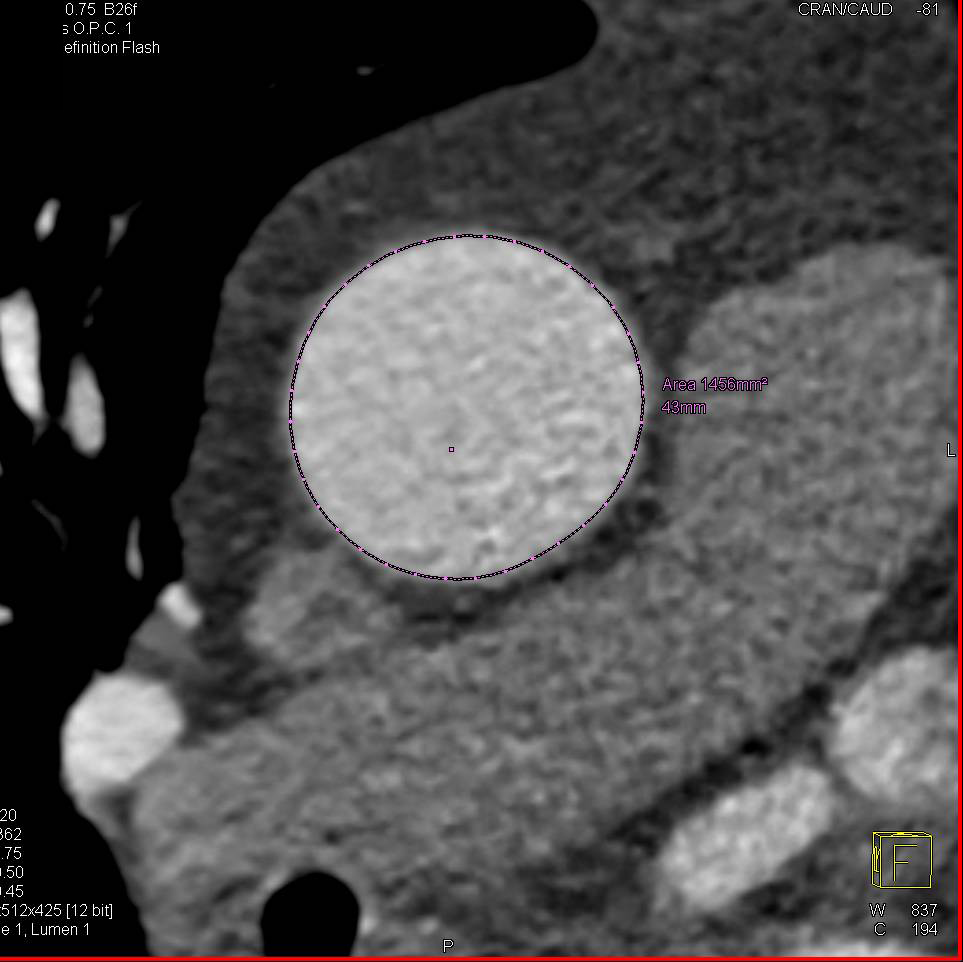 Dilated Aortic Root and Ascending Aorta - CTisus CT Scan