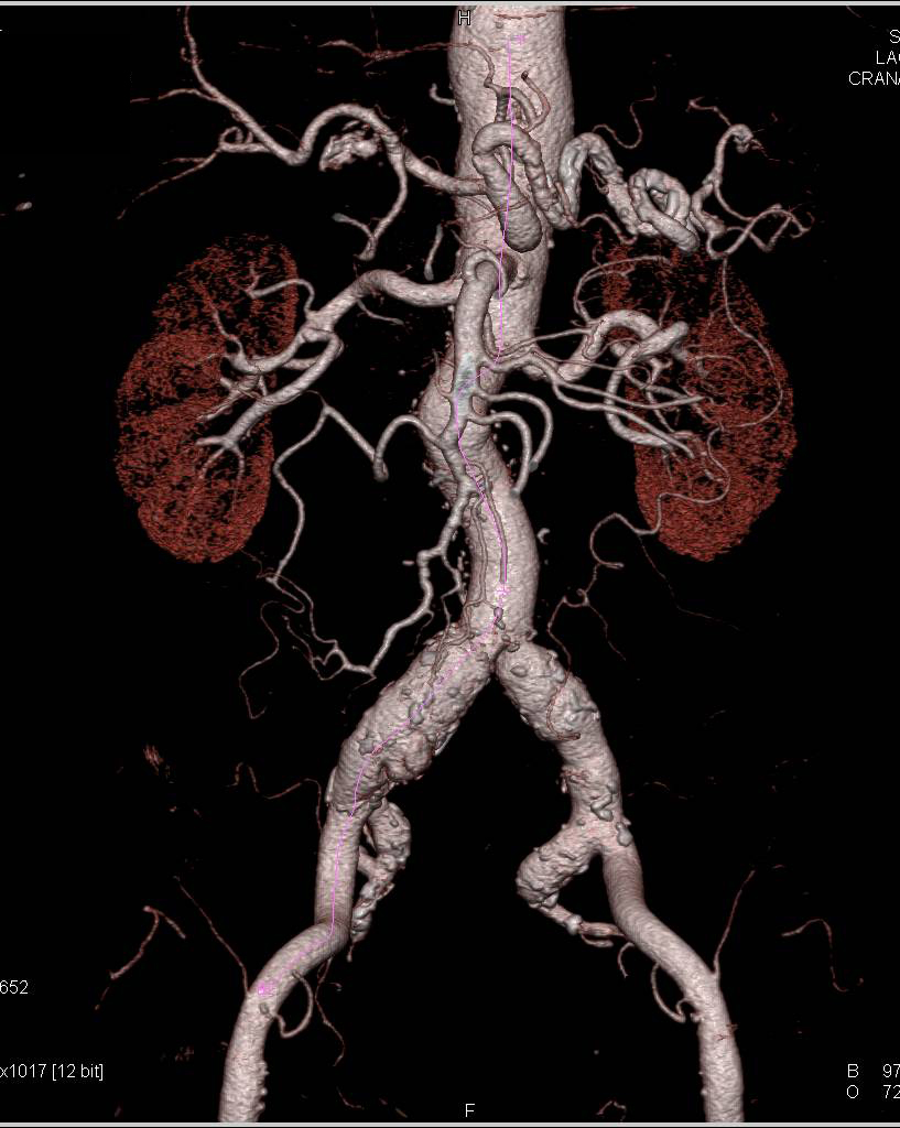 Atherosclerotic Disease Aorta with Bicuspid Valve and Dilated Ascending Aorta - CTisus CT Scan