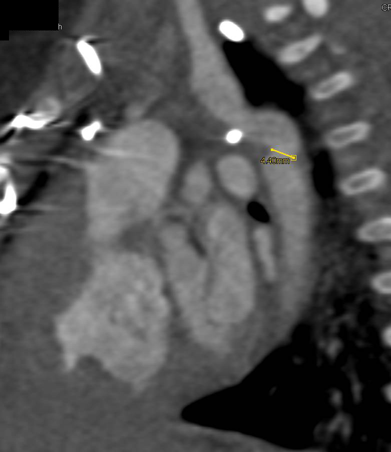 Coarctation of the Aorta - CTisus CT Scan