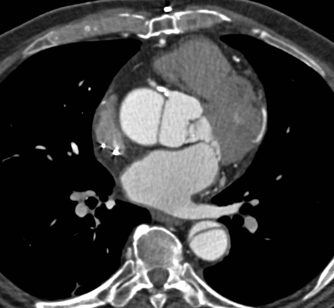 Type A Dissection with Multiple Presentations - CTisus CT Scan