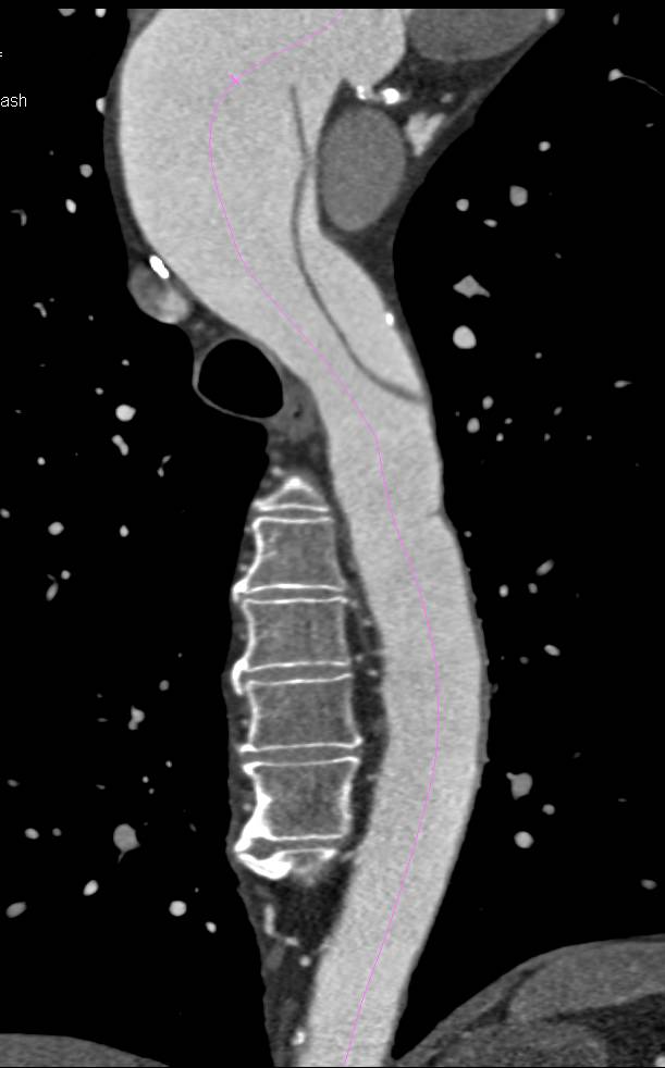 Type A Dissection Extended the Length of the Aorta - CTisus CT Scan