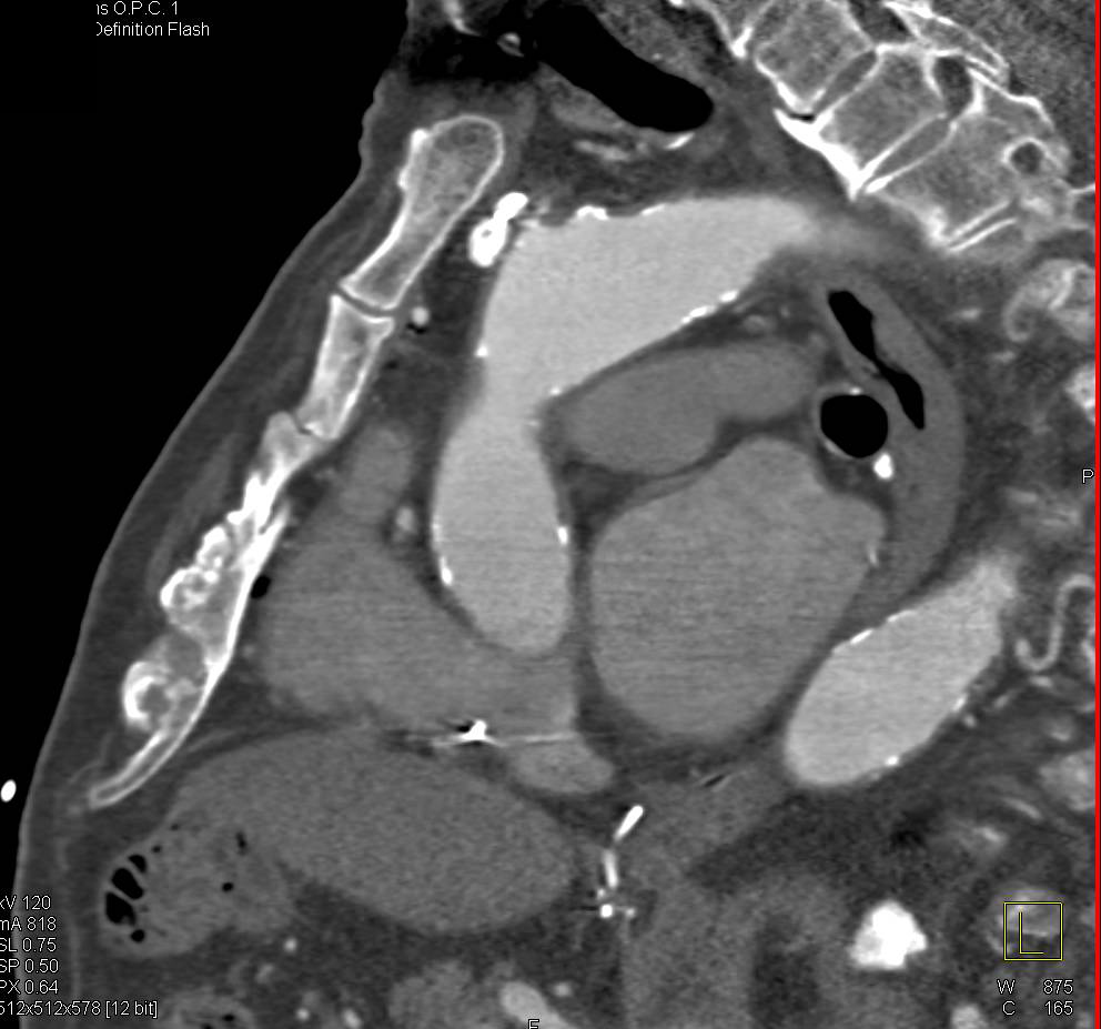 3D Mapping Prior to Redo Median Sternotomy for Aortic Valve Replacement (AVR) - CTisus CT Scan