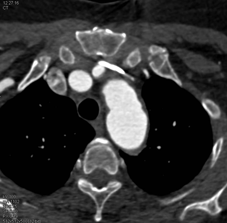 3D Mapping Study of Patient with Ascending Aorta Repair with Aortic Valve Replacement (AVR) as well - CTisus CT Scan