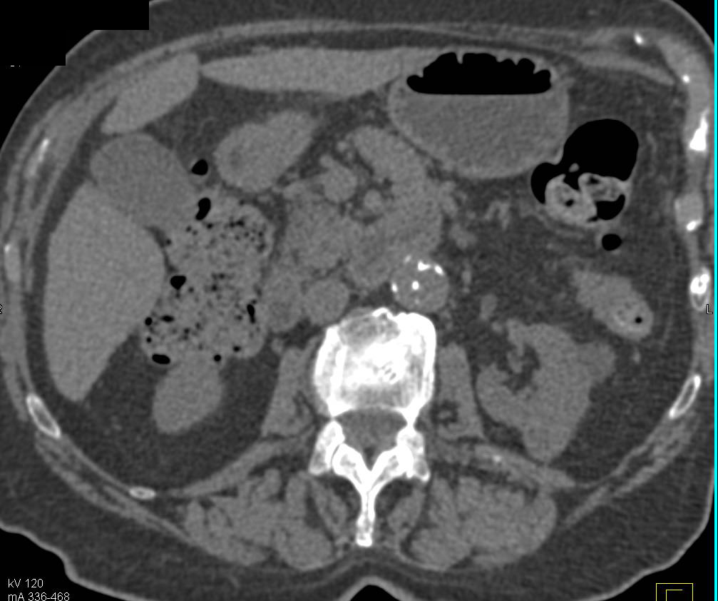 Abdominal Aortic Aneurysm with Ulcerations and High Density Renal Cyst - CTisus CT Scan