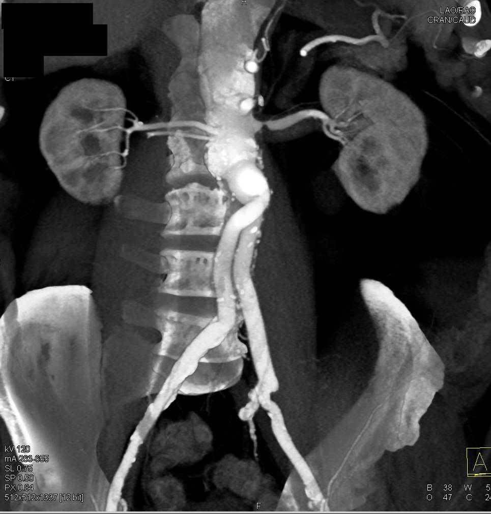 Renal Artery Stenosis in a Patient with Prior Aortic Aneurysm Repair with Aortoiliac Grafts - CTisus CT Scan