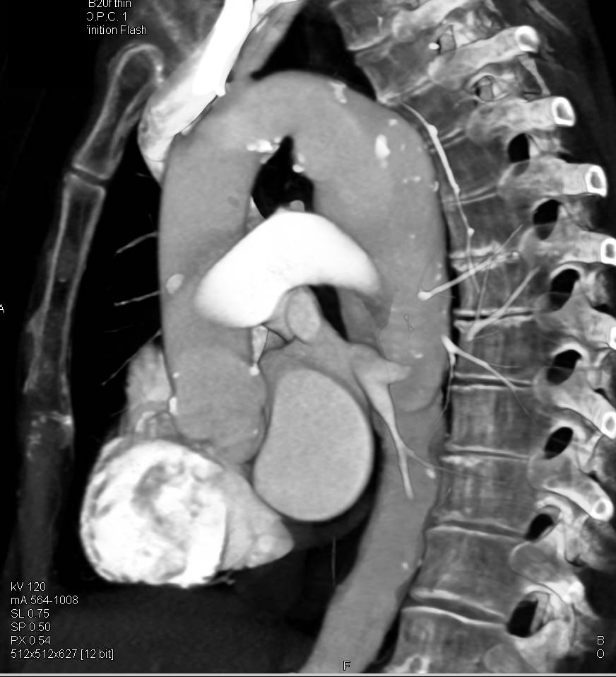 Aneurysm of the Descending Thoracic Aorta - CTisus CT Scan