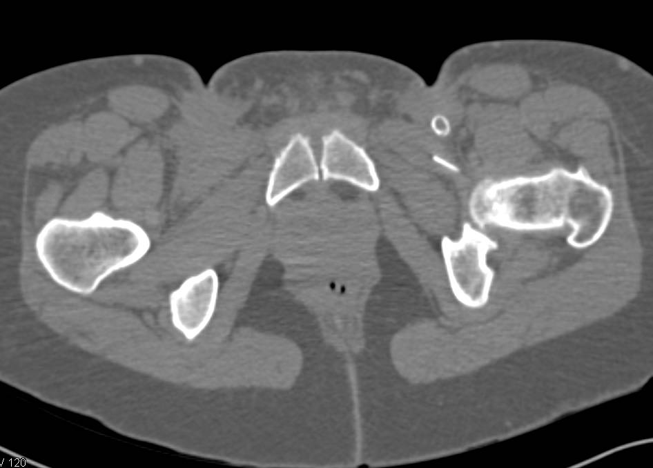 Broken Needle in Left Groin - CTisus CT Scan