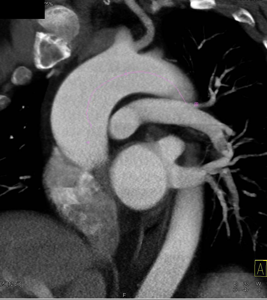 Dilated Ascending Aorta Analyzed with Vessel Tracking - CTisus CT Scan