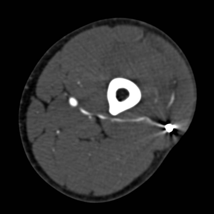 Gunshot to Thigh with CTA Runoff Study Demonstrating No Evidence of Vascular Injury - CTisus CT Scan