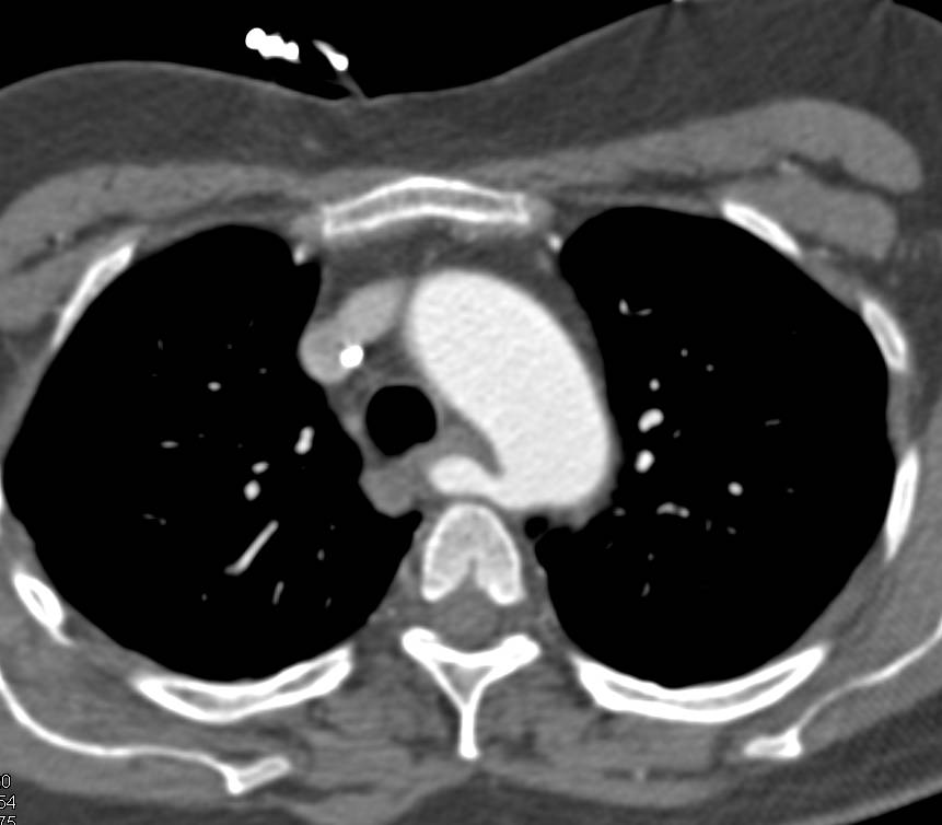Multiple Findings including Aberrant Right Subclavian Artery, Celiac Stenosis, Hepatic and Splenic Artery Aneurysmss - CTisus CT Scan