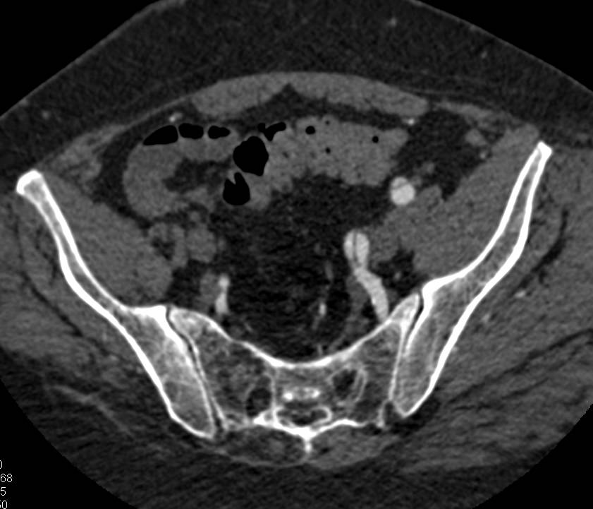 Dissection Left Internal and External Iliac Artery with a Fem-Fem Bypass - CTisus CT Scan