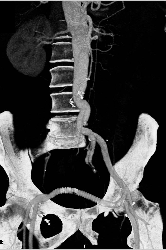 Type B Dissection with Vessel tracking and fem-Fem Bypass - CTisus CT Scan