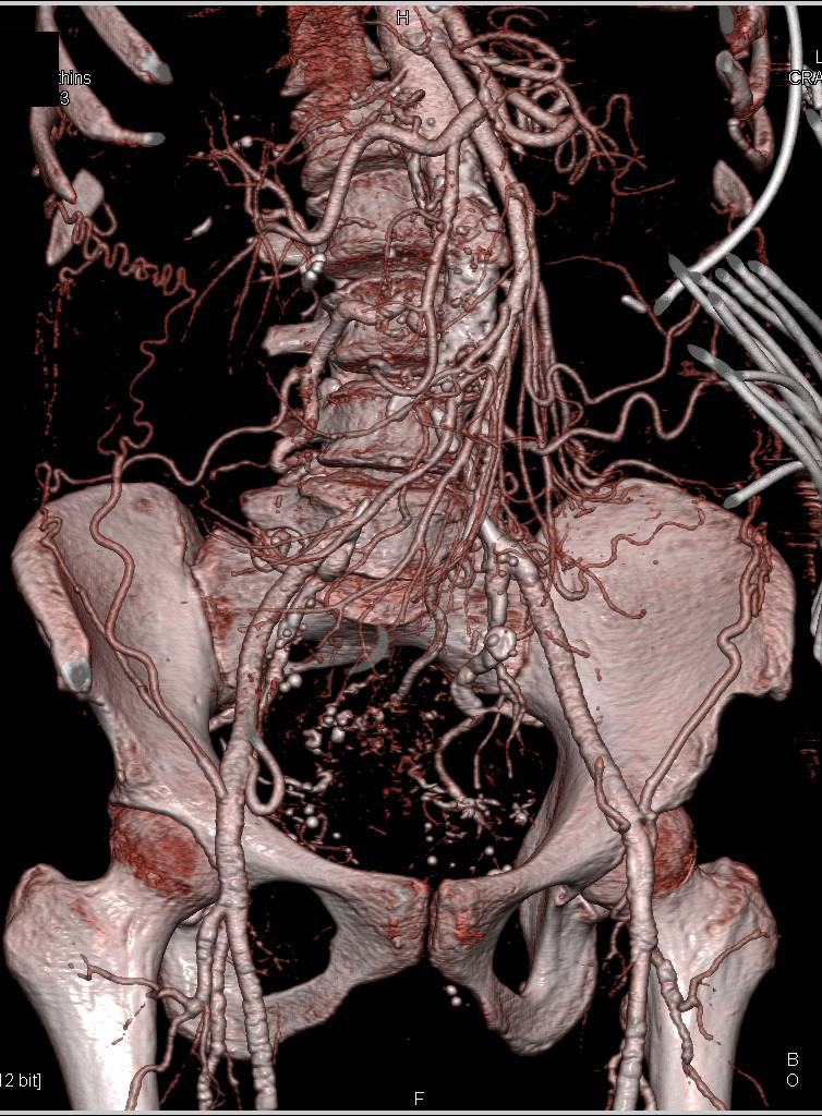 Occlusion of Abdominal Aorta and Collaterals Noted to Re-establish Flow - CTisus CT Scan