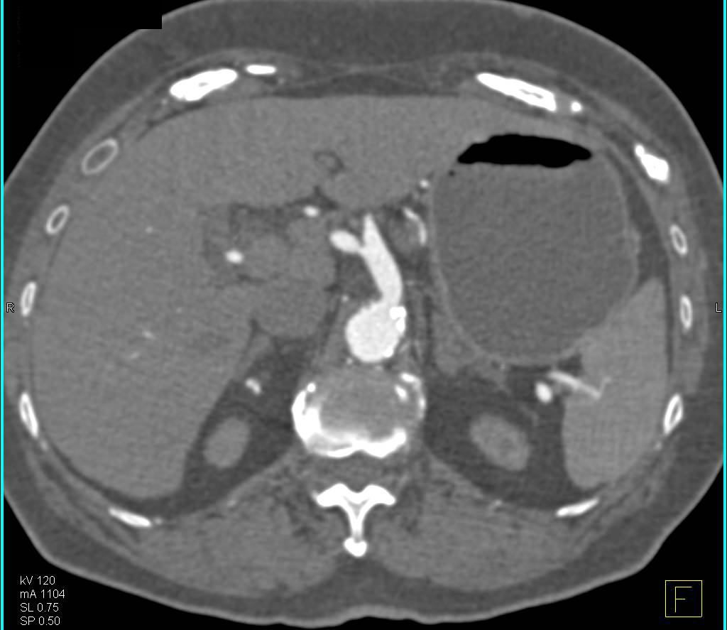 Aortic Aneurysm Repair with Endovascular Stents and a Pretty Fem-Fem Bypass graft - CTisus CT Scan