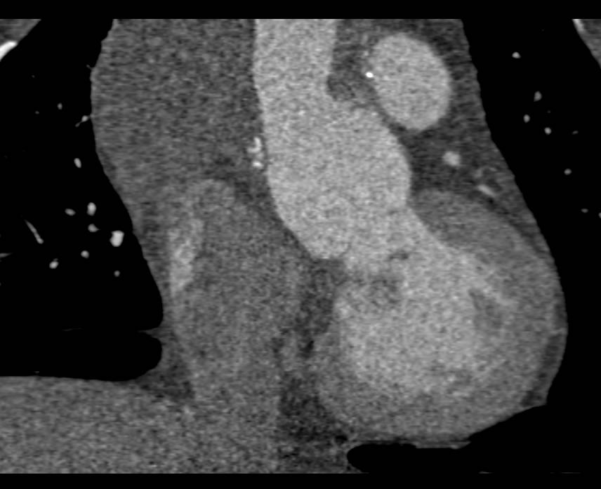 Aortic Root Repair with Reimplantation of the Coronary Arteries - CTisus CT Scan