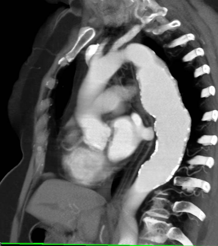 Center Line Mapping of an Aneurysm of the Descending Thoracic Aorta - CTisus CT Scan