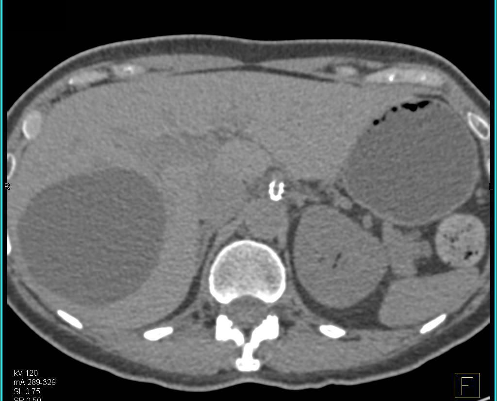 Patent Stent in Celiac Artery is Compresssed. - Vascular Case Studies ...