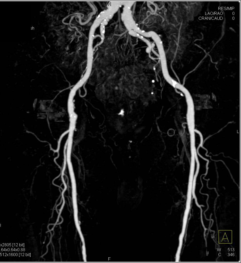 CTA Runoff with Peripheral Vascular Disease - CTisus CT Scan