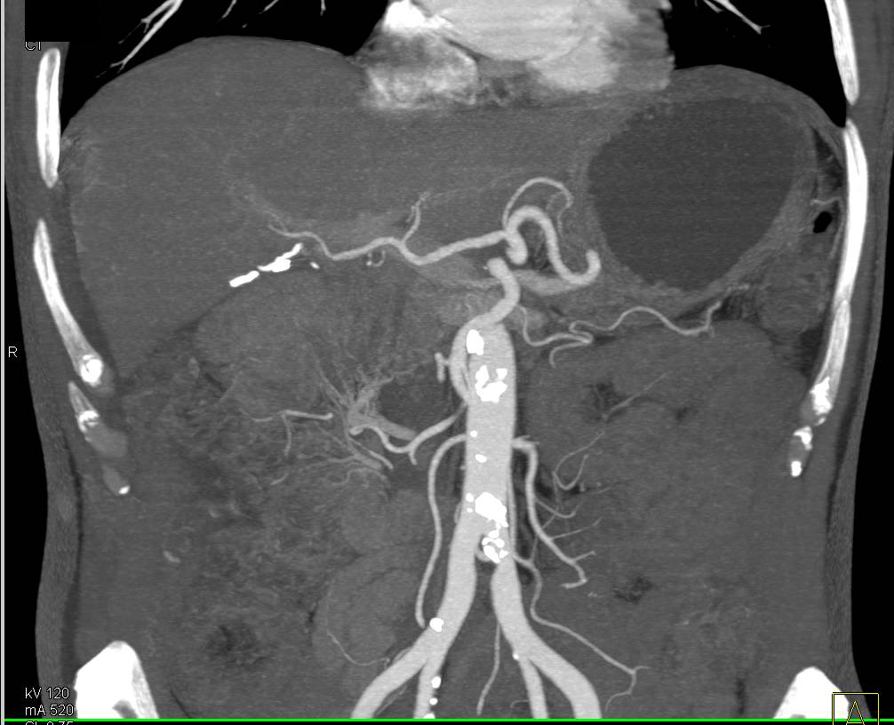 Patent Superior Mesenteric Artery (SMA) Stent - CTisus CT Scan