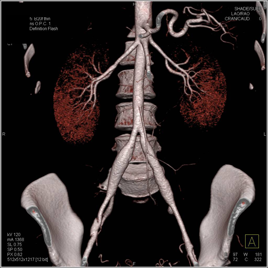 Ehlers-Danlos Syndrome with Vascular Analysis - CTisus CT Scan