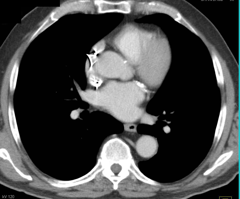 Sarcoma of Right Common Iliac Artery (looks like Thrombus) - CTisus CT Scan