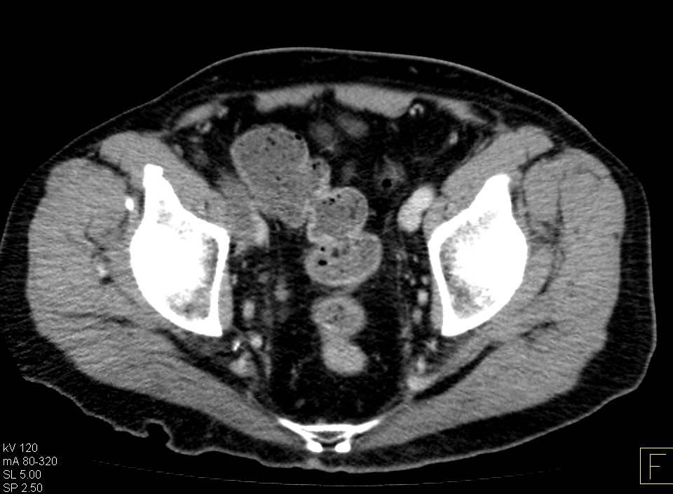 Sarcoma in Right Thigh and Vascular Tumor Thrombus as Well - CTisus CT Scan