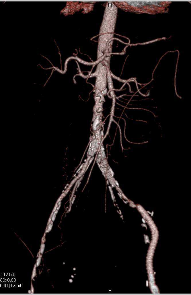 CTA Runoff with Occluded Superficial Femoral Artery (SFA) on the Right and SFA-Popliteal Bypass on the Left - CTisus CT Scan