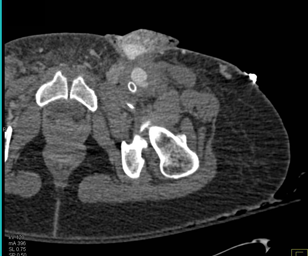 Pseudoaneurysm Near Graft Site with Contrast Extravasation - CTisus CT Scan