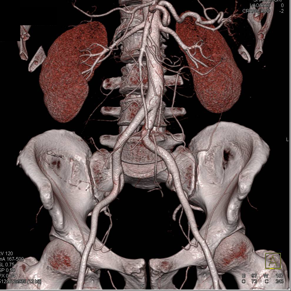 CTA of Normal Iliac Arteries - CTisus CT Scan