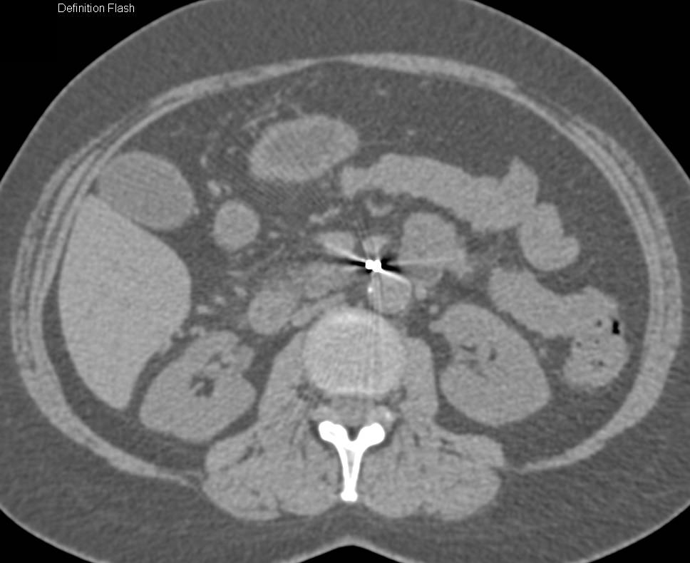 Patent Stent in Celiac Artery - CTisus CT Scan