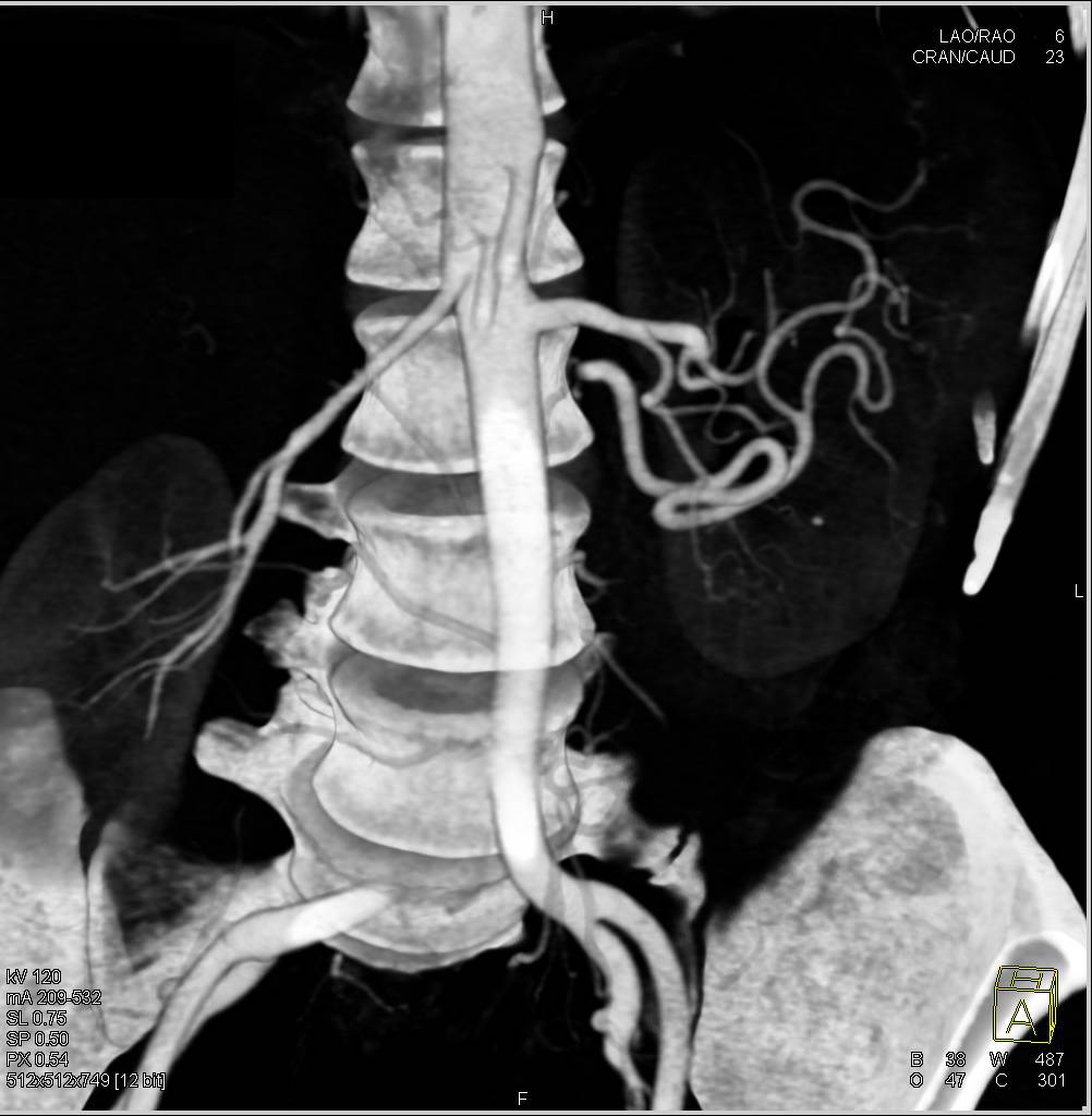 Normal IMA - CTisus CT Scan