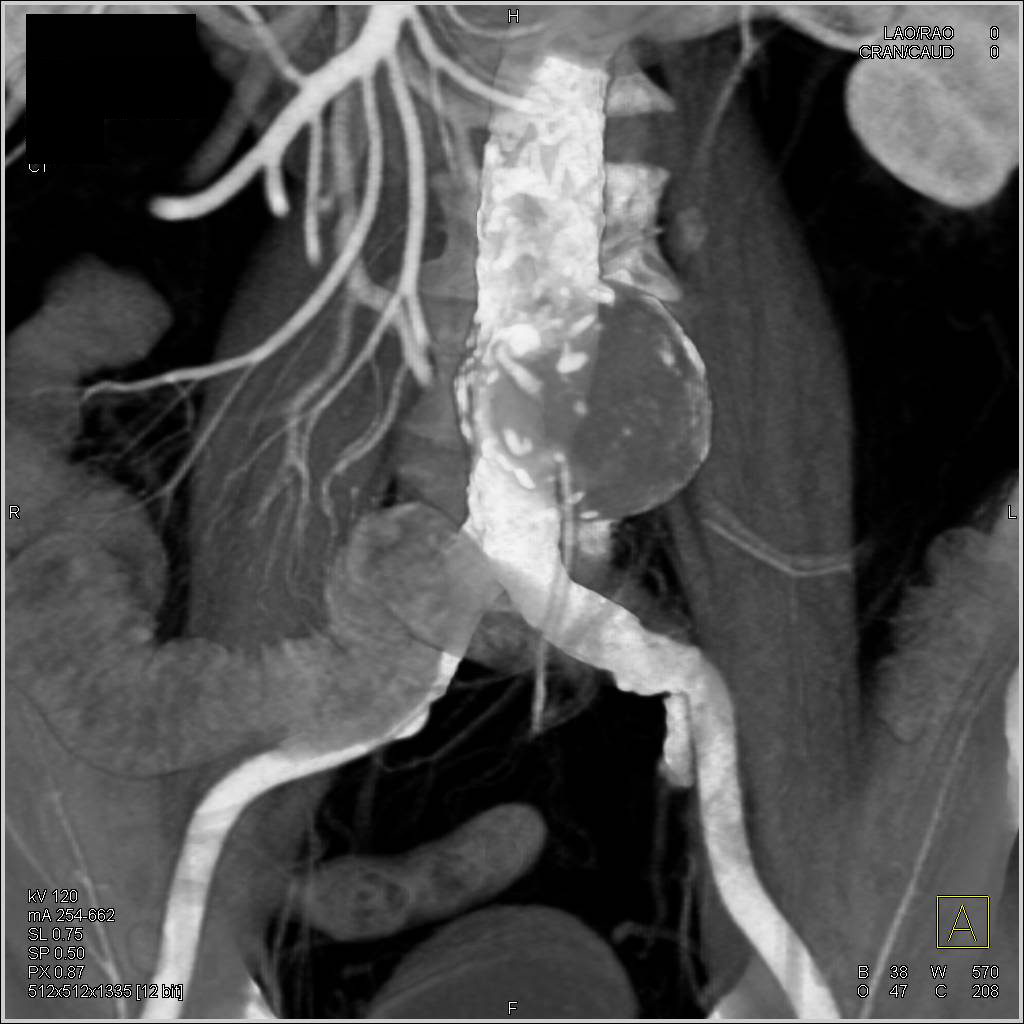 Aortic Aneurysm with IMA off Aneurysm - CTisus CT Scan