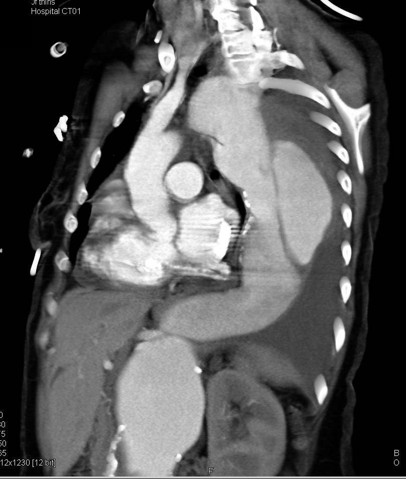 Type B Dissection - CTisus CT Scan