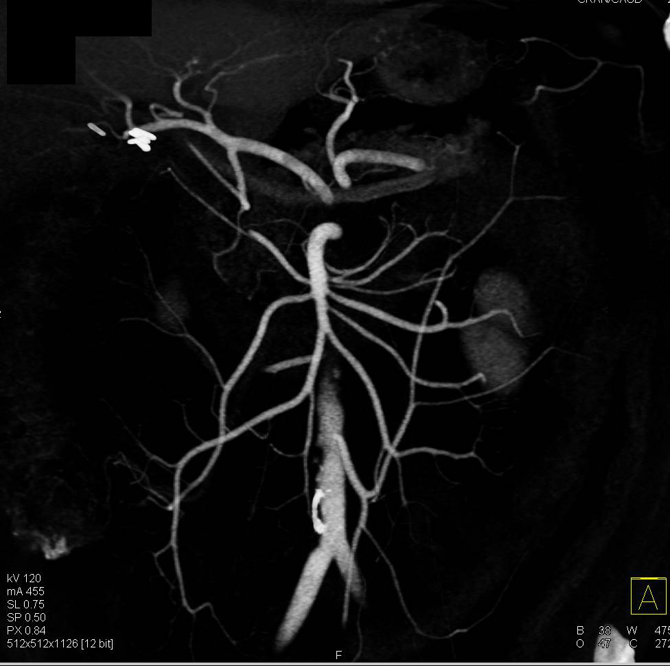Hepatic and Splenic Arteries Arise Directly off the Aorta - CTisus CT Scan
