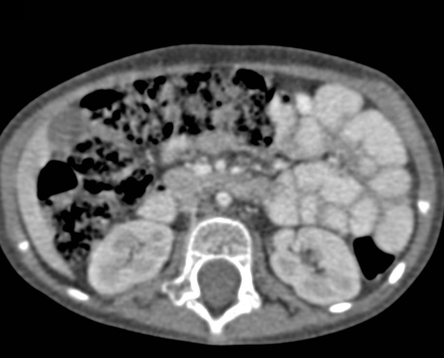 Small Caliber Aorta in Loeys-Dietz Syndrome - CTisus CT Scan