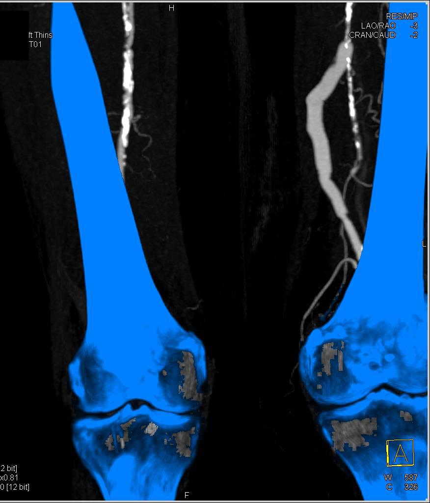 Left External Iliac to Popliteal Artery Graft. Note Proximal Course of the Graft - CTisus CT Scan