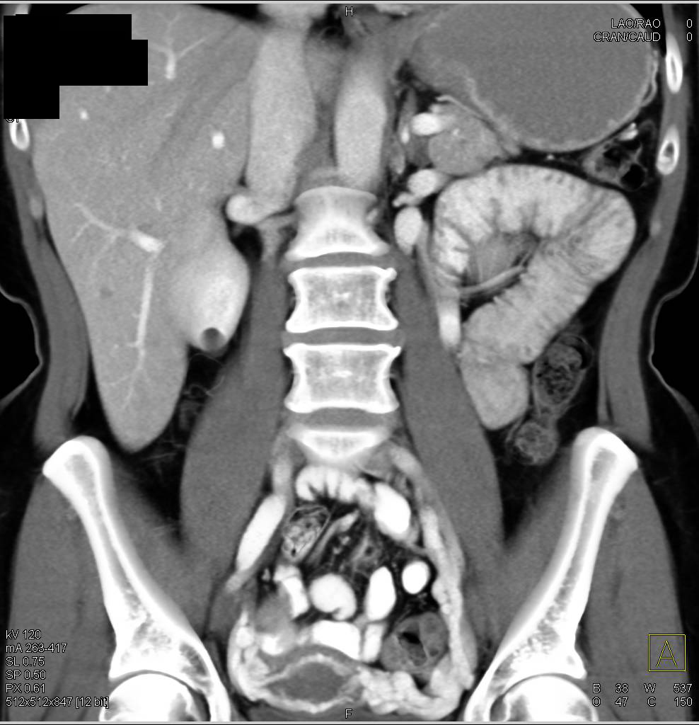 Pelvic Congestion Syndrome - CTisus CT Scan