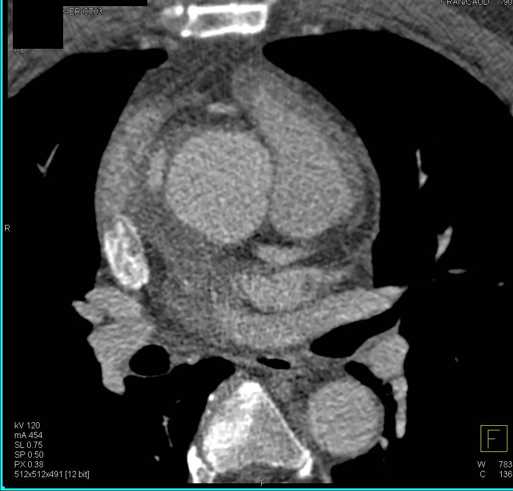 Type A Dissection - CTisus CT Scan