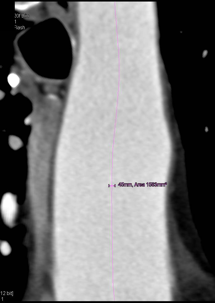 Aneurysm Ascending Aorta - CTisus CT Scan