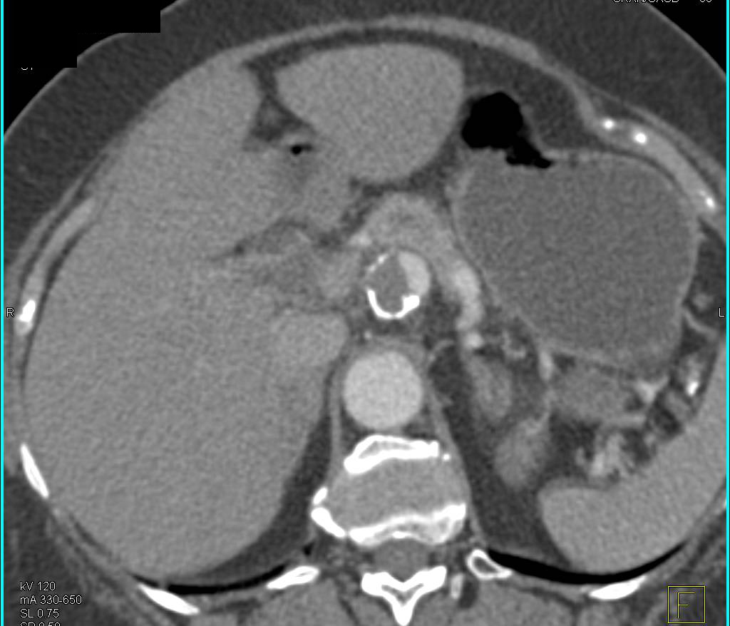 Celiac Artery Aneurysm is Partially Thrombosed - CTisus CT Scan