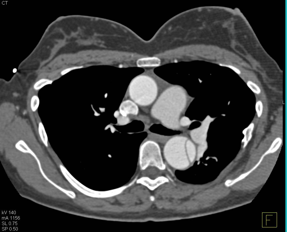 Type B Dissection in a Patient with a Large Meningocele - CTisus CT Scan