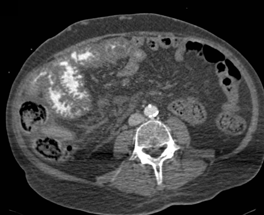 Enteritis Distal Small Bowel due to Infectious Etiology - CTisus CT Scan