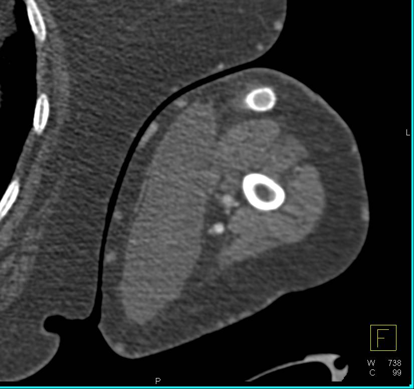 Arteriovenous (AV) Fistulae in the Arm with Stent is Patent - CTisus CT Scan