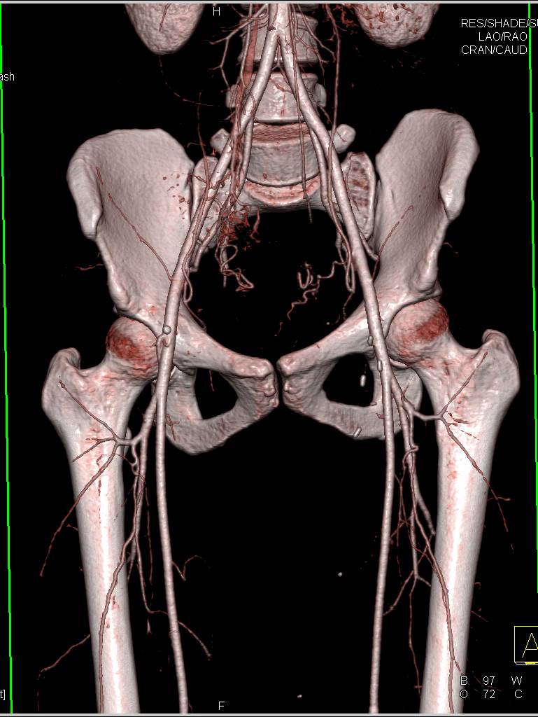 SFA to Posterior Tibial Artery Bypass - Vascular Case Studies - CTisus ...